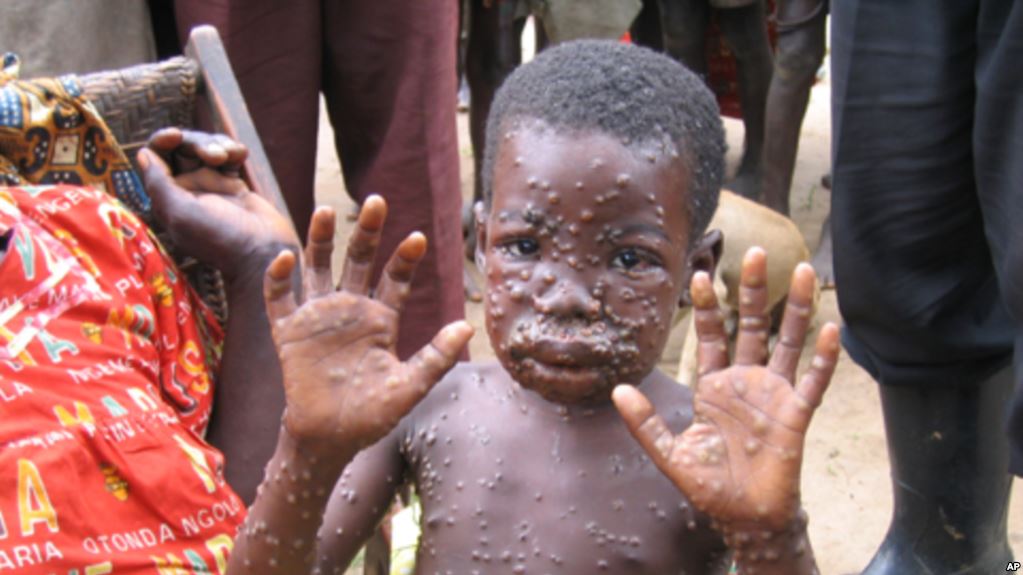 What you should know about the Monkeypox